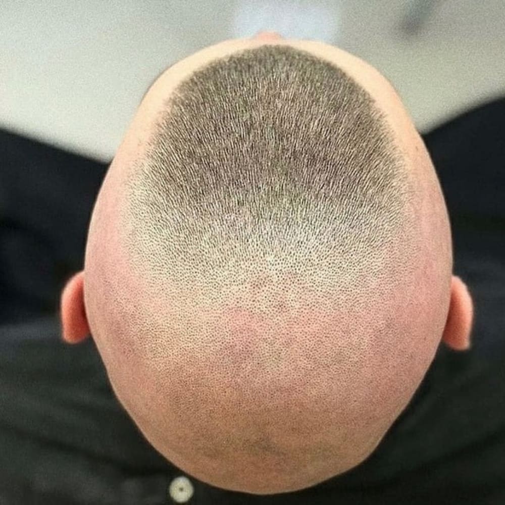 The image shows a person with a high and tight recon haircut, viewed from above. The sides and back of the head are shaved extremely close to the skin, creating a stark contrast with the narrow strip of slightly longer hair on top. This strip runs from the forehead to the crown, maintaining the classic high and tight look with an added emphasis on the minimalist, almost bald sides. The recon version is the boldest variation of the high and tight haircut, characterized by its dramatic, military-inspired appearance. The overall look is striking and highly defined, showcasing precision and a clean finish.