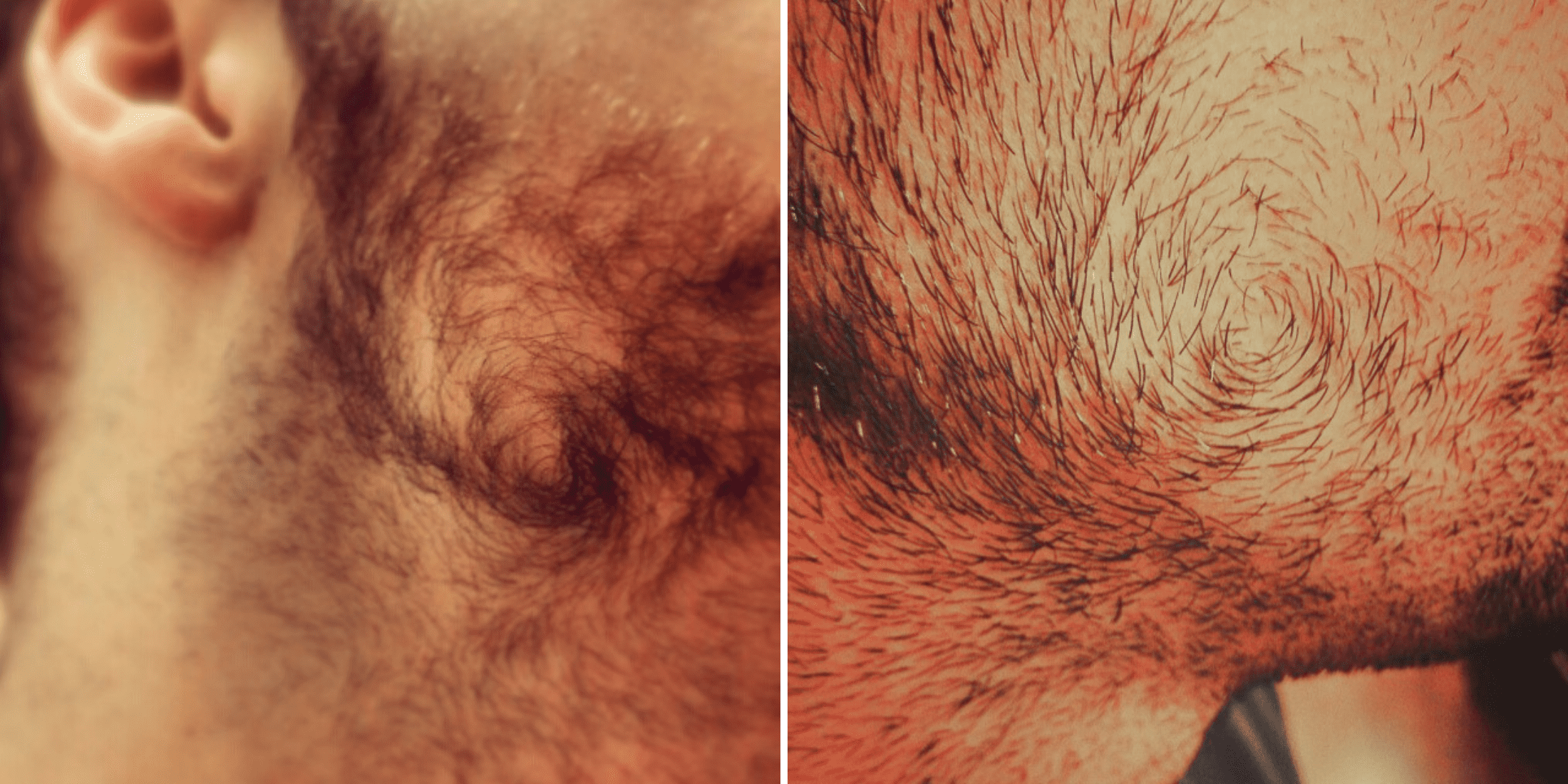 Close-up images showcasing two examples of a beard cowlick: the first with a pronounced swirl on the side of the face, and the second with a tight, circular growth pattern under the chin.