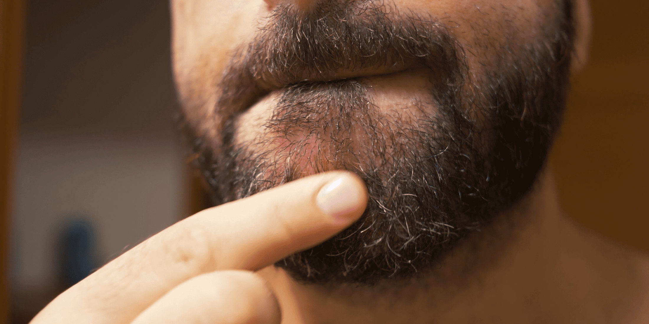 Close-up image of a man with an irritated, dry beard, showing signs of redness and dryness, with a finger pointing at the affected area.